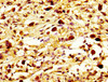 IHC image of CSB-PA015300LA01HU diluted at 1:800 and staining in paraffin-embedded human melanoma performed on a Leica BondTM system. After dewaxing and hydration, antigen retrieval was mediated by high pressure in a citrate buffer (pH 6.0) . Section was blocked with 10% normal goat serum 30min at RT. Then primary antibody (1% BSA) was incubated at 4°C overnight. The primary is detected by a biotinylated secondary antibody and visualized using an HRP conjugated SP system.