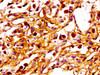 IHC image of CSB-PA018493LA01HU diluted at 1:100 and staining in paraffin-embedded human melanoma performed on a Leica BondTM system. After dewaxing and hydration, antigen retrieval was mediated by high pressure in a citrate buffer (pH 6.0) . Section was blocked with 10% normal goat serum 30min at RT. Then primary antibody (1% BSA) was incubated at 4°C overnight. The primary is detected by a biotinylated secondary antibody and visualized using an HRP conjugated SP system.