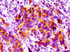 IHC image of CSB-PA018493LA01HU diluted at 1:100 and staining in paraffin-embedded human pancreatic cancer performed on a Leica BondTM system. After dewaxing and hydration, antigen retrieval was mediated by high pressure in a citrate buffer (pH 6.0) . Section was blocked with 10% normal goat serum 30min at RT. Then primary antibody (1% BSA) was incubated at 4°C overnight. The primary is detected by a biotinylated secondary antibody and visualized using an HRP conjugated SP system.