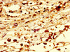 IHC image of CSB-PA019878LA01HU diluted at 1:300 and staining in paraffin-embedded human melanoma performed on a Leica BondTM system. After dewaxing and hydration, antigen retrieval was mediated by high pressure in a citrate buffer (pH 6.0) . Section was blocked with 10% normal goat serum 30min at RT. Then primary antibody (1% BSA) was incubated at 4°C overnight. The primary is detected by a biotinylated secondary antibody and visualized using an HRP conjugated SP system.