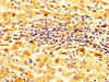 IHC image of CSB-PA020849LA01HU diluted at 1:300 and staining in paraffin-embedded human liver cancer performed on a Leica BondTM system. After dewaxing and hydration, antigen retrieval was mediated by high pressure in a citrate buffer (pH 6.0) . Section was blocked with 10% normal goat serum 30min at RT. Then primary antibody (1% BSA) was incubated at 4°C overnight. The primary is detected by a biotinylated secondary antibody and visualized using an HRP conjugated SP system.