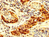 IHC image of CSB-PA020849LA01HU diluted at 1:300 and staining in paraffin-embedded human bladder cancer performed on a Leica BondTM system. After dewaxing and hydration, antigen retrieval was mediated by high pressure in a citrate buffer (pH 6.0) . Section was blocked with 10% normal goat serum 30min at RT. Then primary antibody (1% BSA) was incubated at 4°C overnight. The primary is detected by a biotinylated secondary antibody and visualized using an HRP conjugated SP system.