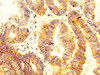 IHC image of CSB-PA021383LA01HU diluted at 1:300 and staining in paraffin-embedded human colon cancer performed on a Leica BondTM system. After dewaxing and hydration, antigen retrieval was mediated by high pressure in a citrate buffer (pH 6.0) . Section was blocked with 10% normal goat serum 30min at RT. Then primary antibody (1% BSA) was incubated at 4°C overnight. The primary is detected by a biotinylated secondary antibody and visualized using an HRP conjugated SP system.