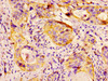 IHC image of CSB-PA10869A0Rb diluted at 1:300 and staining in paraffin-embedded human cervical cancer performed on a Leica BondTM system. After dewaxing and hydration, antigen retrieval was mediated by high pressure in a citrate buffer (pH 6.0) . Section was blocked with 10% normal goat serum 30min at RT. Then primary antibody (1% BSA) was incubated at 4°C overnight. The primary is detected by a biotinylated secondary antibody and visualized using an HRP conjugated SP system.