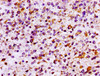 IHC image of CSB-PA600091LA01HU diluted at 1:100 and staining in paraffin-embedded human glioma performed on a Leica BondTM system. After dewaxing and hydration, antigen retrieval was mediated by high pressure in a citrate buffer (pH 6.0) . Section was blocked with 10% normal goat serum 30min at RT. Then primary antibody (1% BSA) was incubated at 4°C overnight. The primary is detected by a biotinylated secondary antibody and visualized using an HRP conjugated SP system.