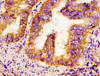 IHC image of CSB-PA613605LA01HU diluted at 1:300 and staining in paraffin-embedded human endometrial cancer performed on a Leica BondTM system. After dewaxing and hydration, antigen retrieval was mediated by high pressure in a citrate buffer (pH 6.0) . Section was blocked with 10% normal goat serum 30min at RT. Then primary antibody (1% BSA) was incubated at 4°C overnight. The primary is detected by a biotinylated secondary antibody and visualized using an HRP conjugated SP system.