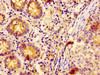IHC image of CSB-PA615539LA01HU diluted at 1:400 and staining in paraffin-embedded human colon cancer performed on a Leica BondTM system. After dewaxing and hydration, antigen retrieval was mediated by high pressure in a citrate buffer (pH 6.0) . Section was blocked with 10% normal goat serum 30min at RT. Then primary antibody (1% BSA) was incubated at 4°C overnight. The primary is detected by a biotinylated secondary antibody and visualized using an HRP conjugated SP system.
