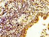 IHC image of CSB-PA621973LA01HU diluted at 1:200 and staining in paraffin-embedded human lung cancer performed on a Leica BondTM system. After dewaxing and hydration, antigen retrieval was mediated by high pressure in a citrate buffer (pH 6.0) . Section was blocked with 10% normal goat serum 30min at RT. Then primary antibody (1% BSA) was incubated at 4°C overnight. The primary is detected by a biotinylated secondary antibody and visualized using an HRP conjugated SP system. IHC image of CSB-PA621973LA01HU diluted at 1:200 and staining in paraffin-embedded human lung cancer performed on a Leica BondTM system. After dewaxing and hydration, antigen retrieval was mediated by high pressure in a citrate buffer (pH 6.0) . Section was blocked with 10% normal goat serum 30min at RT. Then primary antibody (1% BSA) was incubated at 4°C overnight. The primary is detected by a biotinylated secondary antibody and visualized using an HRP conjugated SP system.