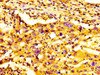 IHC image of CSB-PA768769LA01HU diluted at 1:300 and staining in paraffin-embedded human lung cancer performed on a Leica BondTM system. After dewaxing and hydration, antigen retrieval was mediated by high pressure in a citrate buffer (pH 6.0) . Section was blocked with 10% normal goat serum 30min at RT. Then primary antibody (1% BSA) was incubated at 4°C overnight. The primary is detected by a biotinylated secondary antibody and visualized using an HRP conjugated SP system.