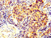 IHC image of CSB-PA819471LA01HU diluted at 1:300 and staining in paraffin-embedded human bladder cancer performed on a Leica BondTM system. After dewaxing and hydration, antigen retrieval was mediated by high pressure in a citrate buffer (pH 6.0) . Section was blocked with 10% normal goat serum 30min at RT. Then primary antibody (1% BSA) was incubated at 4°C overnight. The primary is detected by a biotinylated secondary antibody and visualized using an HRP conjugated SP system.