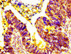 IHC image of CSB-PA823469LA01HU diluted at 1:500 and staining in paraffin-embedded human ovarian cancer performed on a Leica BondTM system. After dewaxing and hydration, antigen retrieval was mediated by high pressure in a citrate buffer (pH 6.0) . Section was blocked with 10% normal goat serum 30min at RT. Then primary antibody (1% BSA) was incubated at 4°C overnight. The primary is detected by a biotinylated secondary antibody and visualized using an HRP conjugated SP system.