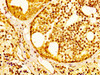 IHC image of CSB-PA836239LA01HU diluted at 1:300 and staining in paraffin-embedded human prostate cancer performed on a Leica BondTM system. After dewaxing and hydration, antigen retrieval was mediated by high pressure in a citrate buffer (pH 6.0) . Section was blocked with 10% normal goat serum 30min at RT. Then primary antibody (1% BSA) was incubated at 4°C overnight. The primary is detected by a biotinylated secondary antibody and visualized using an HRP conjugated SP system.