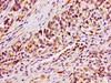 IHC image of CSB-PA858728LA01HU diluted at 1:100 and staining in paraffin-embedded human colon cancer performed on a Leica BondTM system. After dewaxing and hydration, antigen retrieval was mediated by high pressure in a citrate buffer (pH 6.0) . Section was blocked with 10% normal goat serum 30min at RT. Then primary antibody (1% BSA) was incubated at 4°C overnight. The primary is detected by a biotinylated secondary antibody and visualized using an HRP conjugated SP system.