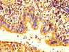 IHC image of CSB-PA859116LA01HU diluted at 1:200 and staining in paraffin-embedded human lung cancer performed on a Leica BondTM system. After dewaxing and hydration, antigen retrieval was mediated by high pressure in a citrate buffer (pH 6.0) . Section was blocked with 10% normal goat serum 30min at RT. Then primary antibody (1% BSA) was incubated at 4°C overnight. The primary is detected by a biotinylated secondary antibody and visualized using an HRP conjugated SP system.