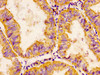 IHC image of CSB-PA866283LA01HU diluted at 1:200 and staining in paraffin-embedded human endometrial cancer performed on a Leica BondTM system. After dewaxing and hydration, antigen retrieval was mediated by high pressure in a citrate buffer (pH 6.0) . Section was blocked with 10% normal goat serum 30min at RT. Then primary antibody (1% BSA) was incubated at 4°C overnight. The primary is detected by a biotinylated secondary antibody and visualized using an HRP conjugated SP system.