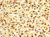 IHC image of CSB-PA872550LA01HU diluted at 1:600 and staining in paraffin-embedded human glioma performed on a Leica BondTM system. After dewaxing and hydration, antigen retrieval was mediated by high pressure in a citrate buffer (pH 6.0) . Section was blocked with 10% normal goat serum 30min at RT. Then primary antibody (1% BSA) was incubated at 4°C overnight. The primary is detected by a biotinylated secondary antibody and visualized using an HRP conjugated SP system.