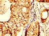 IHC image of CSB-PA880059LA01HU diluted at 1:300 and staining in paraffin-embedded human cervical cancer performed on a Leica BondTM system. After dewaxing and hydration, antigen retrieval was mediated by high pressure in a citrate buffer (pH 6.0) . Section was blocked with 10% normal goat serum 30min at RT. Then primary antibody (1% BSA) was incubated at 4°C overnight. The primary is detected by a biotinylated secondary antibody and visualized using an HRP conjugated SP system.