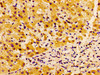 IHC image of CSB-PA897526LA01HU diluted at 1:100 and staining in paraffin-embedded human liver cancer performed on a Leica BondTM system. After dewaxing and hydration, antigen retrieval was mediated by high pressure in a citrate buffer (pH 6.0) . Section was blocked with 10% normal goat serum 30min at RT. Then primary antibody (1% BSA) was incubated at 4°C overnight. The primary is detected by a biotinylated secondary antibody and visualized using an HRP conjugated SP system.