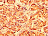 IHC image of CSB-PA012877LA01HU diluted at 1:300 and staining in paraffin-embedded human liver cancer performed on a Leica BondTM system. After dewaxing and hydration, antigen retrieval was mediated by high pressure in a citrate buffer (pH 6.0) . Section was blocked with 10% normal goat serum 30min at RT. Then primary antibody (1% BSA) was incubated at 4°C overnight. The primary is detected by a biotinylated secondary antibody and visualized using an HRP conjugated SP system.