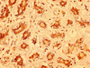IHC image of CSB-PA015389LA01HU diluted at 1:400 and staining in paraffin-embedded human breast cancer performed on a Leica BondTM system. After dewaxing and hydration, antigen retrieval was mediated by high pressure in a citrate buffer (pH 6.0) . Section was blocked with 10% normal goat serum 30min at RT. Then primary antibody (1% BSA) was incubated at 4°C overnight. The primary is detected by a biotinylated secondary antibody and visualized using an HRP conjugated SP system.