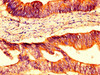 IHC image of CSB-PA016263LA01HU diluted at 1:400 and staining in paraffin-embedded human colon cancer performed on a Leica BondTM system. After dewaxing and hydration, antigen retrieval was mediated by high pressure in a citrate buffer (pH 6.0) . Section was blocked with 10% normal goat serum 30min at RT. Then primary antibody (1% BSA) was incubated at 4°C overnight. The primary is detected by a biotinylated secondary antibody and visualized using an HRP conjugated SP system.