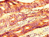 IHC image of CSB-PA614393LA01HU diluted at 1:500 and staining in paraffin-embedded human colon cancer performed on a Leica BondTM system. After dewaxing and hydration, antigen retrieval was mediated by high pressure in a citrate buffer (pH 6.0) . Section was blocked with 10% normal goat serum 30min at RT. Then primary antibody (1% BSA) was incubated at 4°C overnight. The primary is detected by a biotinylated secondary antibody and visualized using an HRP conjugated SP system. IHC image of CSB-PA614393LA01HU diluted at 1:500 and staining in paraffin-embedded human colon cancer performed on a Leica BondTM system. After dewaxing and hydration, antigen retrieval was mediated by high pressure in a citrate buffer (pH 6.0) . Section was blocked with 10% normal goat serum 30min at RT. Then primary antibody (1% BSA) was incubated at 4°C overnight. The primary is detected by a biotinylated secondary antibody and visualized using an HRP conjugated SP system.