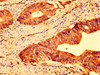 IHC image of CSB-PA863956LA01HU diluted at 1:500 and staining in paraffin-embedded human colon cancer performed on a Leica BondTM system. After dewaxing and hydration, antigen retrieval was mediated by high pressure in a citrate buffer (pH 6.0) . Section was blocked with 10% normal goat serum 30min at RT. Then primary antibody (1% BSA) was incubated at 4°C overnight. The primary is detected by a biotinylated secondary antibody and visualized using an HRP conjugated SP system.