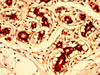 IHC image of CSB-PA887159LA01HU diluted at 1:300 and staining in paraffin-embedded human breast cancer performed on a Leica BondTM system. After dewaxing and hydration, antigen retrieval was mediated by high pressure in a citrate buffer (pH 6.0) . Section was blocked with 10% normal goat serum 30min at RT. Then primary antibody (1% BSA) was incubated at 4°C overnight. The primary is detected by a biotinylated secondary antibody and visualized using an HRP conjugated SP system.