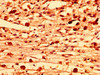 IHC image of CSB-PA896921LA01HU diluted at 1:300 and staining in paraffin-embedded human melanoma performed on a Leica BondTM system. After dewaxing and hydration, antigen retrieval was mediated by high pressure in a citrate buffer (pH 6.0) . Section was blocked with 10% normal goat serum 30min at RT. Then primary antibody (1% BSA) was incubated at 4°C overnight. The primary is detected by a biotinylated secondary antibody and visualized using an HRP conjugated SP system.