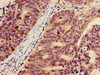 Immunohistochemistry of paraffin-embedded human colon cancer using CSB-PA010418OA18nacHU at dilution of 1:100 Immunohistochemistry of paraffin-embedded human colon cancer using CSB-PA010418OA18nacHU at dilution of 1:100