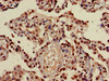 Immunohistochemistry of paraffin-embedded human lung cancer using CSB-PA010418OA23nacHU at dilution of 1:100