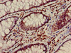 Immunohistochemistry of paraffin-embedded human colon cancer using CSB-PA010418PA28nacHU at dilution of 1:100 Immunohistochemistry of paraffin-embedded human colon cancer using CSB-PA010418PA28nacHU at dilution of 1:100