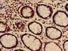 Immunohistochemistry of paraffin-embedded human colon cancer using CSB-PA010418PA27nme1HU at dilution of 1:100
