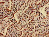 Immunohistochemistry of paraffin-embedded human lung cancer using CSB-PA010418PA27nme1HU at dilution of 1:100