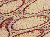 Immunohistochemistry of paraffin-embedded human colon cancer using CSB-PA010418OA28nacHU at dilution of 1:100