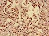 Immunohistochemistry of paraffin-embedded human lung cancer using CSB-PA010418OA28nacHU at dilution of 1:100