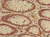 Immunohistochemistry of paraffin-embedded human colon cancer using CSB-PA010418PA27nme3HU at dilution of 1:100