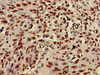 Immunohistochemistry of paraffin-embedded human lung cancer using CSB-PA010418PA27nme3HU at dilution of 1:100