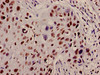 Immunohistochemistry of paraffin-embedded human cervical cancer using CSB-PA010429PA12nacHU at dilution of 1:100