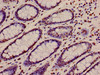 Immunohistochemistry of paraffin-embedded human colon cancer using CSB-PA010429PA12nacHU at dilution of 1:100