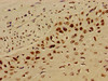 Immunohistochemistry of paraffin-embedded human cervical cancer using CSB-PA010429OA12nacHU at dilution of 1:100