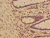 Immunohistochemistry of paraffin-embedded human colon cancer using CSB-PA010418OA17nme2HU at dilution of 1:100