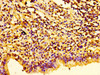 Immunohistochemistry of paraffin-embedded human lung cancer using CSB-PA010380PA26nphHU at dilution of 1:100