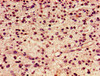 Immunohistochemistry of paraffin-embedded human glioma using CSB-PA010389PA119ncrHU at dilution of 1:100