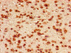 Immunohistochemistry of paraffin-embedded human glioma using CSB-PA010389PA95nforHU at dilution of 1:100