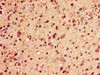 Immunohistochemistry of paraffin-embedded human glioma using CSB-PA010389PA125ncrHU at dilution of 1:100