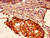 Immunohistochemistry of paraffin-embedded human breast cancer using CSB-PA010389PA125ncrHU at dilution of 1:100