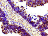 Immunohistochemistry of paraffin-embedded human ovarian cancer using CSB-PA010379PA146nphHU at dilution of 1:100