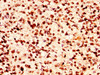 IHC image of CSB-PA010389PA118ncrHU diluted at 1:50 and staining in paraffin-embedded human glioma performed on a Leica BondTM system. After dewaxing and hydration, antigen retrieval was mediated by high pressure in a citrate buffer (pH 6.0) . Section was blocked with 10% normal goat serum 30min at RT. Then primary antibody (1% BSA) was incubated at 4°C overnight. The primary is detected by a biotinylated secondary antibody and visualized using an HRP conjugated SP system.