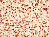 IHC image of CSB-PA010389OA09nhibHU diluted at 1:50 and staining in paraffin-embedded human glioma performed on a Leica BondTM system. After dewaxing and hydration, antigen retrieval was mediated by high pressure in a citrate buffer (pH 6.0) . Section was blocked with 10% normal goat serum 30min at RT. Then primary antibody (1% BSA) was incubated at 4°C overnight. The primary is detected by a biotinylated secondary antibody and visualized using an HRP conjugated SP system.